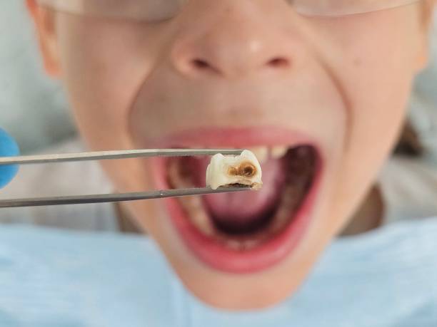 Best Emergency Dental Care for Broken or Chipped Teeth in Fairmont, NC